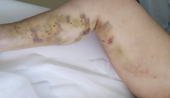 a person with a bruised leg and a wound on their arm