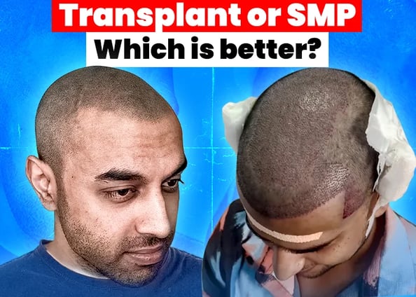 Hair transplanet vs. Scalp micropigmentation_ATRUBARBER