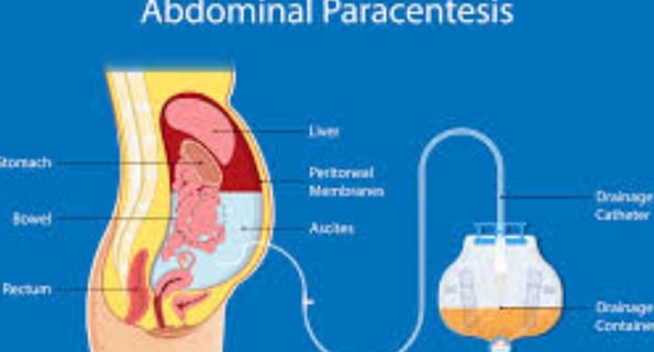 peritoneocentesis or laparocentesis, is a medical procedure