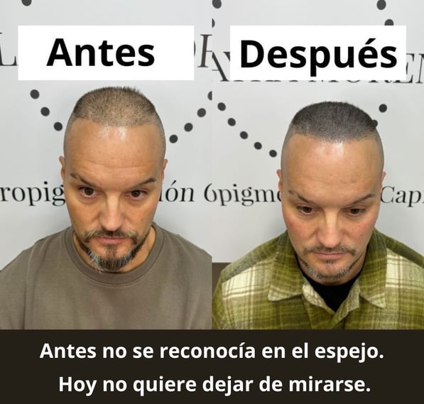 Redensificación con micropigmentación capilar tras injerto en hombre – Madrid