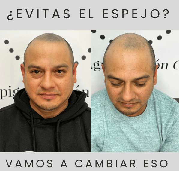 Redensificación capilar con micropigmentación en hombre calvo. Imagen real en Madrid antes y después