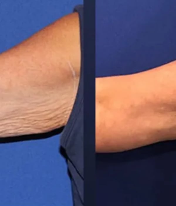 Tratamento Ultraformer para flacidez dos braços