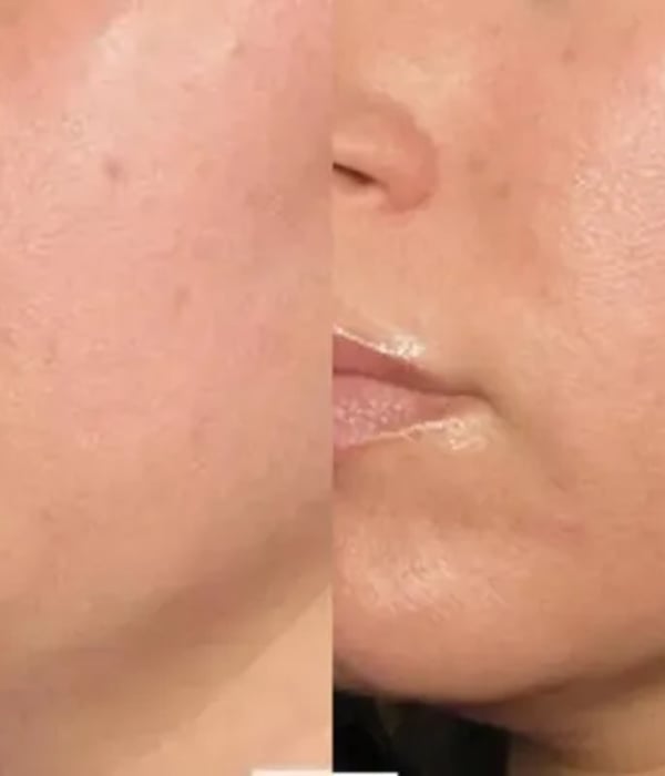 Tratamento de redução de papada com Ultraformer