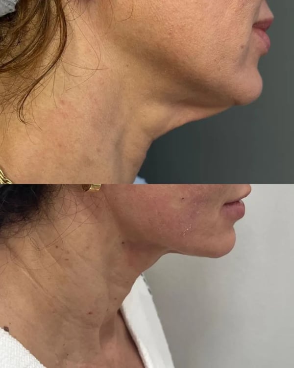Tratamento de papada com Ultraformer