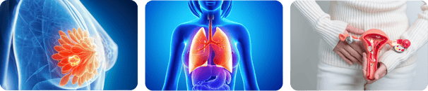 Breast cancer, lung cancer and cervical cancer treatments by Dr.Runu Sharma, expert Oncologist at Ut