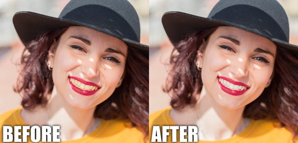 before and after teeth whitening fashion editing
