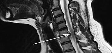 Cervical Spine And Prolapse-Dr. T. Aravindh MBBS, MS( ORTHO)