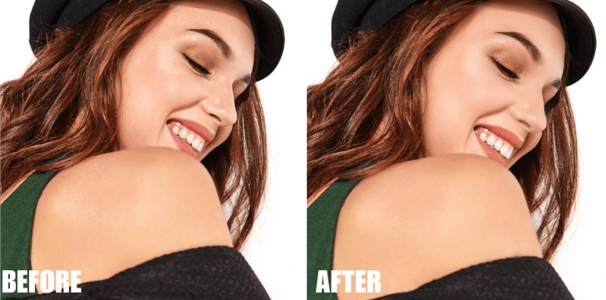 teeth-whitening