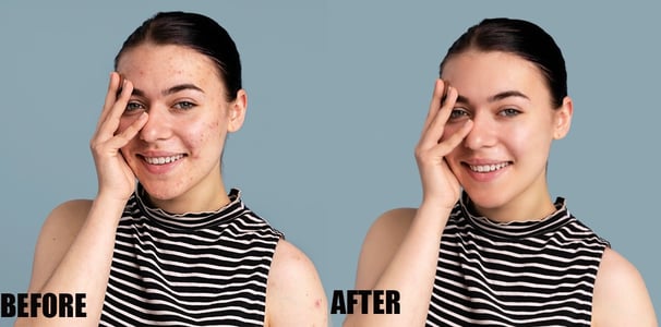 pimple-or-acne-removal