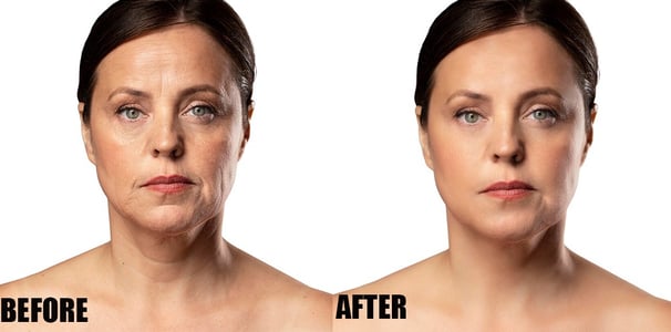 wrinkle-removal