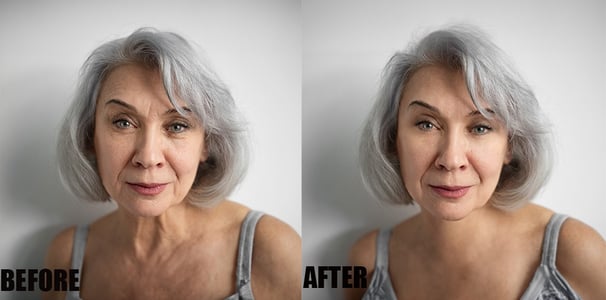 wrinkle-or-scar-marks-removal