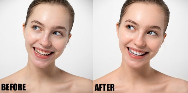 teeth-whitening