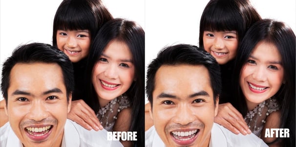 teeth-whitening