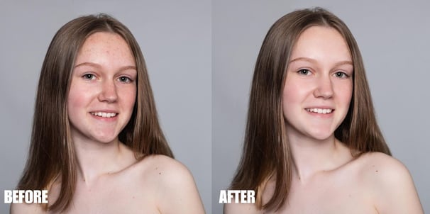 blemish-and-scar-removal