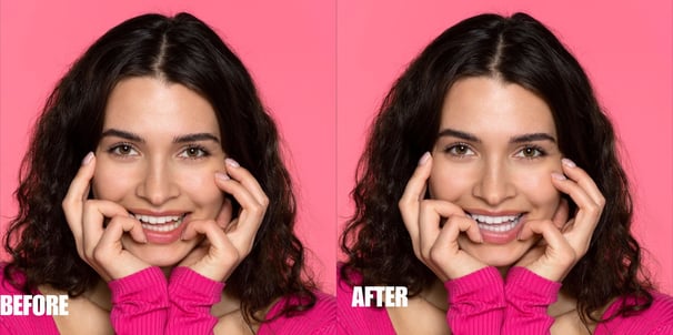 teeth-color-correction