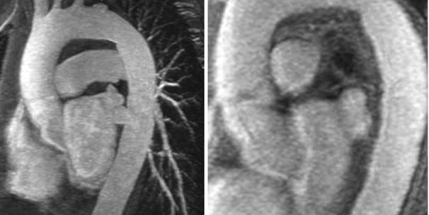 Pericardcheck aortic