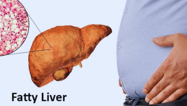 fatty liver & the only hope for the patients