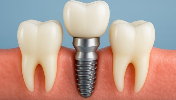 Implants Dentaires à Dentiste Saint Louis Marseille