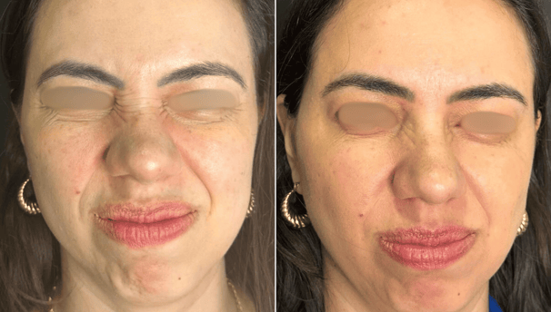 Botox-preenchimento-labial-bio-estimulador-de-colageno-em-pitanga-região-dra.-josiane