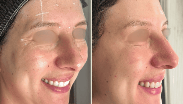 Botox-preenchimento-labial-bio-estimulador-de-colageno-em-pitanga-região-dra.-josiane