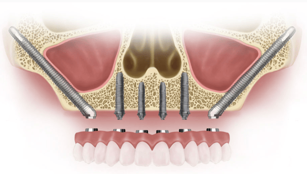 a dental implanting procedure for implanting teeth