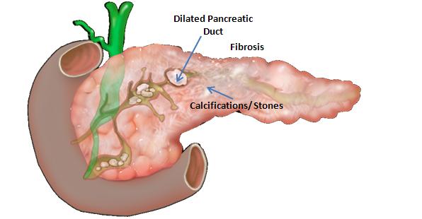 Chronic pancreatitis GASTRO FOUNDATION