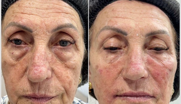 Botox-preenchimento-labial-bio-estimulador-de-colageno-em-pitanga-região-dra.-josiane