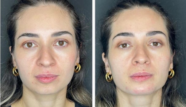 Botox-preenchimento-labial-bio-estimulador-de-colageno-em-pitanga-região-dra.-josiane