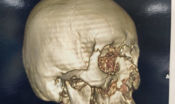 Facial fracture after car accident