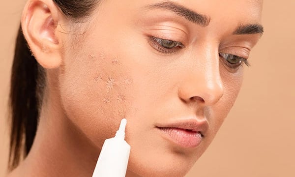 Anwendung von Creme an einer Frau zur Akne-Behandlung