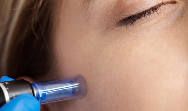 Anwendung der Microneedling Technologie mithilfe eines Pen