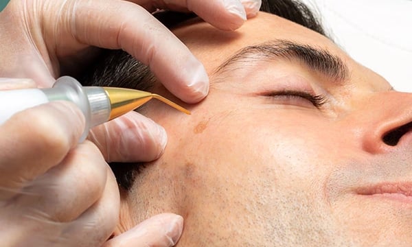 Plasma Pen Anwendung an einem Mann