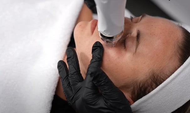 Radiofrequenz Microneedling Behandlung an einer Frau