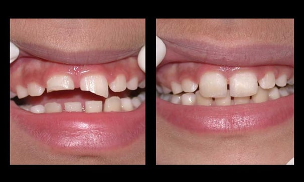 kids teeth