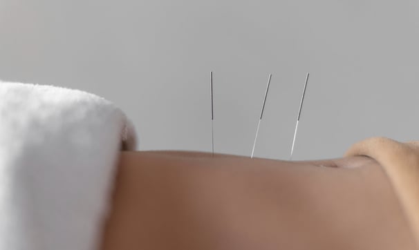 Acupuncture needles gently inserted into skin during treatment.