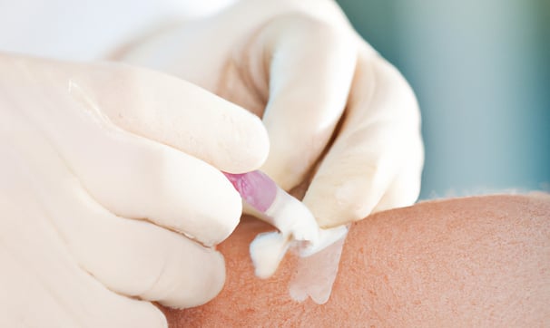 Superglue for wound care