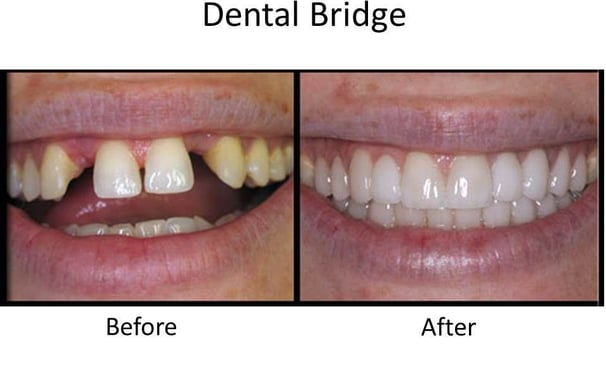 missing teeth