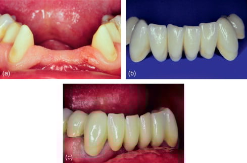 missing teeth