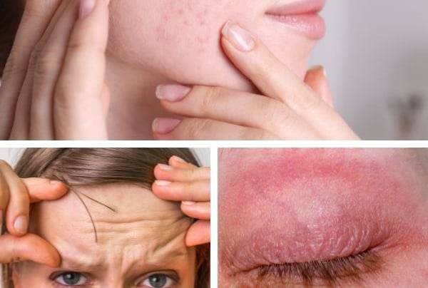 a woman with acne skin and a woman with acne