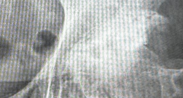 artrosis de cadera