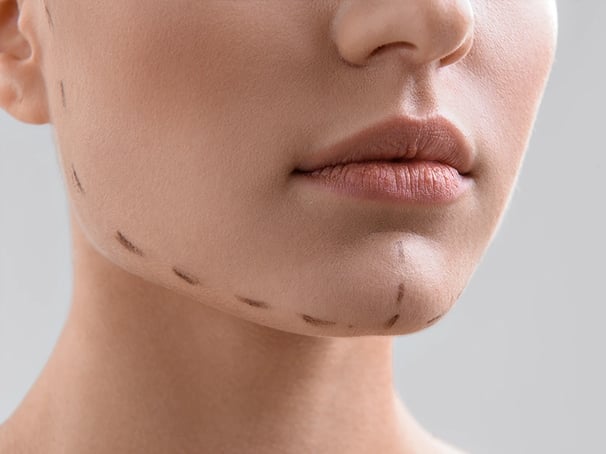 Close-up of a chin with surgical markings for a cosmetic procedure.