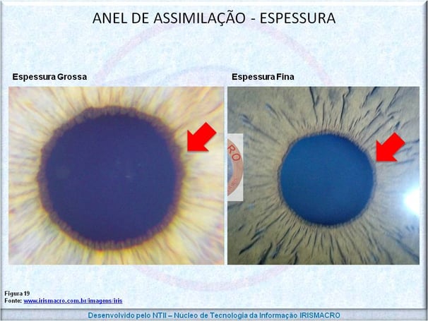Orla pupilar Interna - OPI - Irismacro Iridologia