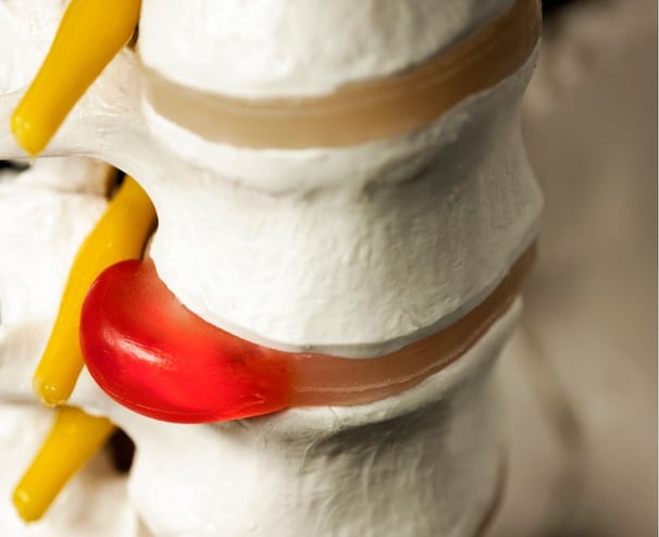 photo of the vertebrae in the spine separated by discs. One bulging disc is causing sciatica.