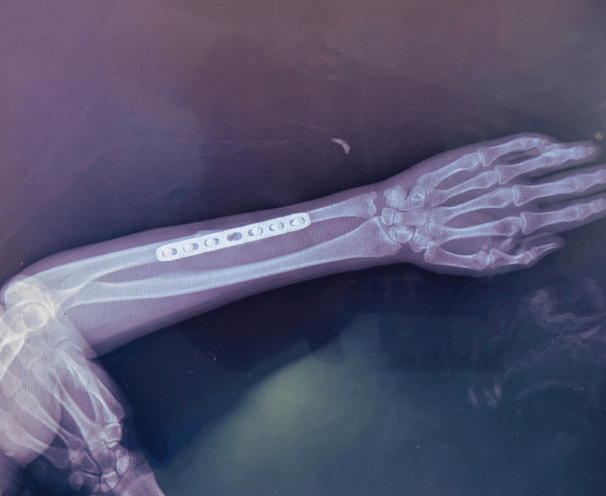 Placa recta para radio y cúbito