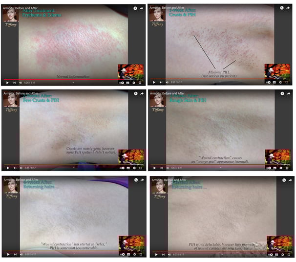 skin after electrolysis treatment