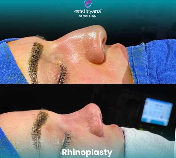 Rhinoplasty before and after