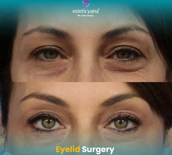 blepharoplasty before and after