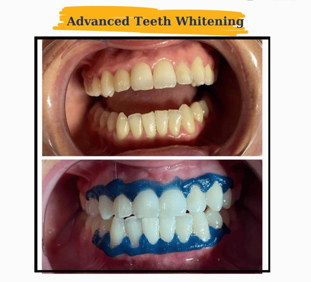 Teeth Whitening