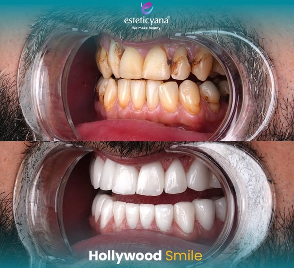 Hollywood smile before and after