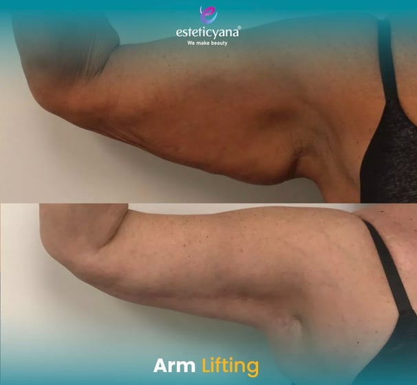 Arm lift before and after